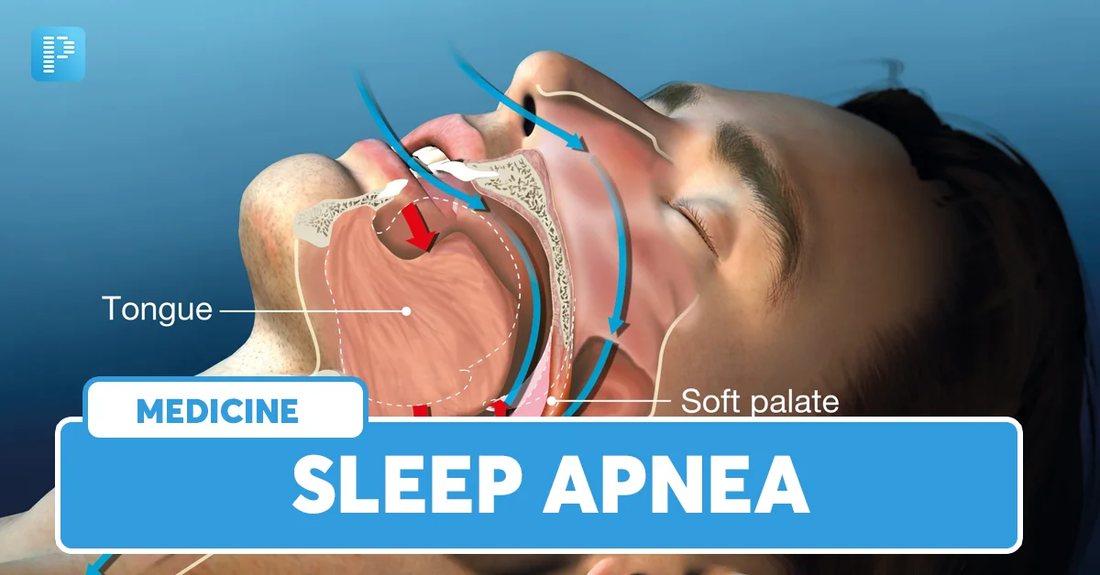Understanding Sleep Apnea: Symptoms, Diagnosis, Treatment & Prevention Tips