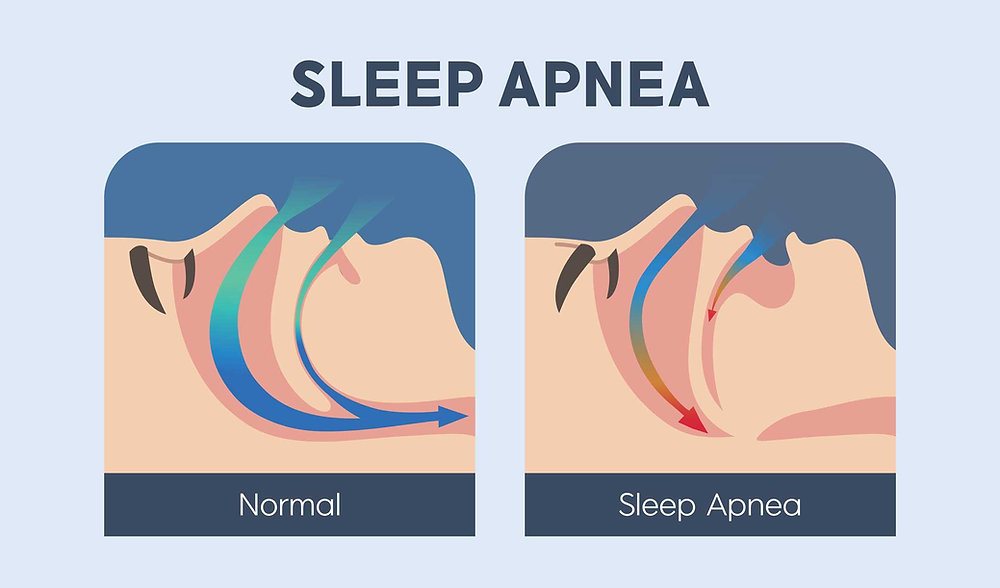 Understanding Sleep Apnea: Symptoms, Diagnosis, Treatment & Prevention Tips